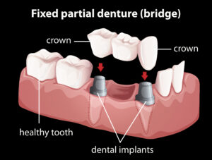 how-to-choose-the-right-crown-and-bridge-material-for-your-patient